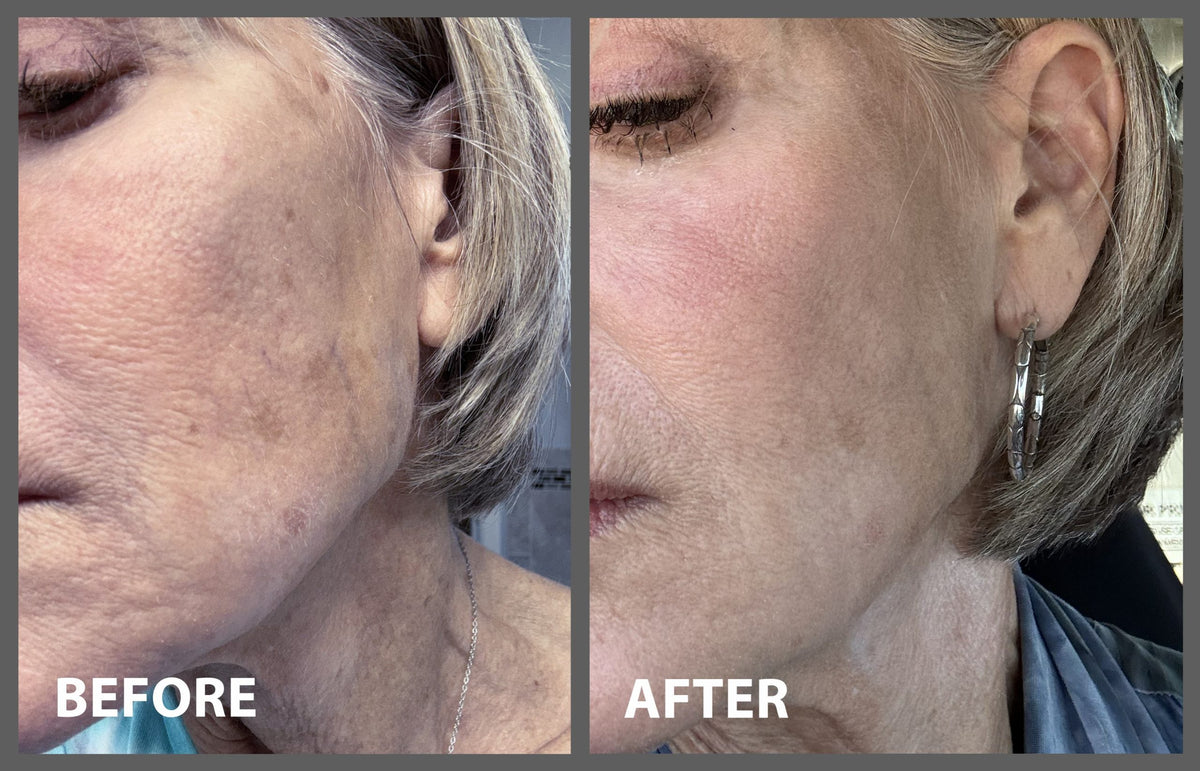 Shelly before after Peptide Serum scaled b5b45d83 dc1f 491f 9051 9039ce342e72 1200x